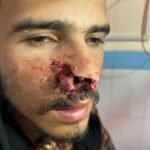 Successful reconstruction of a dog bite-damaged nose