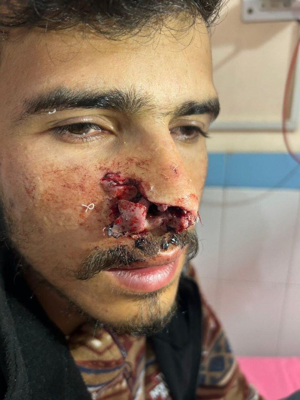 Successful reconstruction of a dog bite-damaged nose